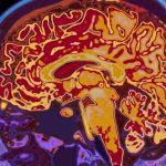 Covid linked to risk of mental illness and brain disorder, study suggests
